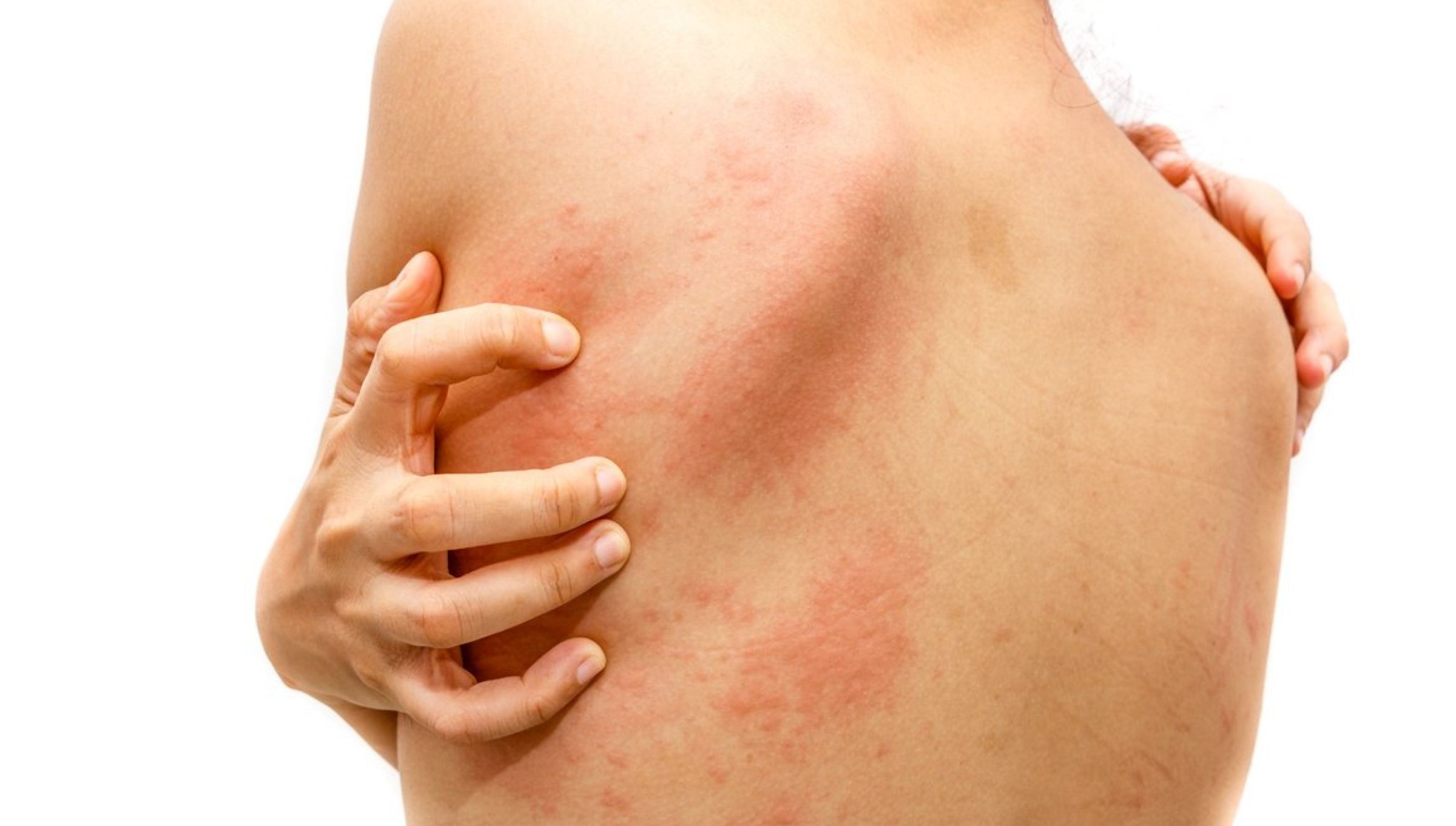 Skin bacterial infections