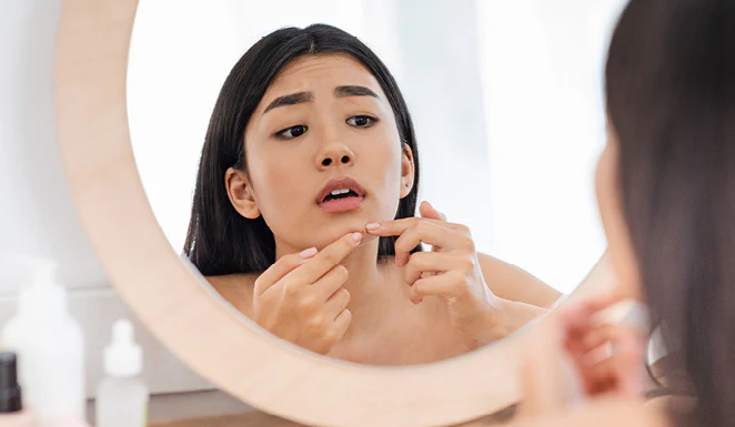 The Ultimate Guide to Managing Spots and Pimples at Home