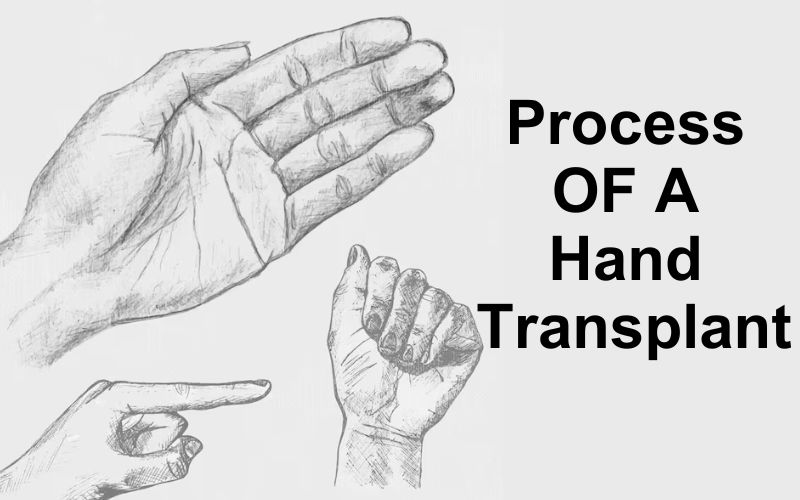 Process of a Hand Transplant