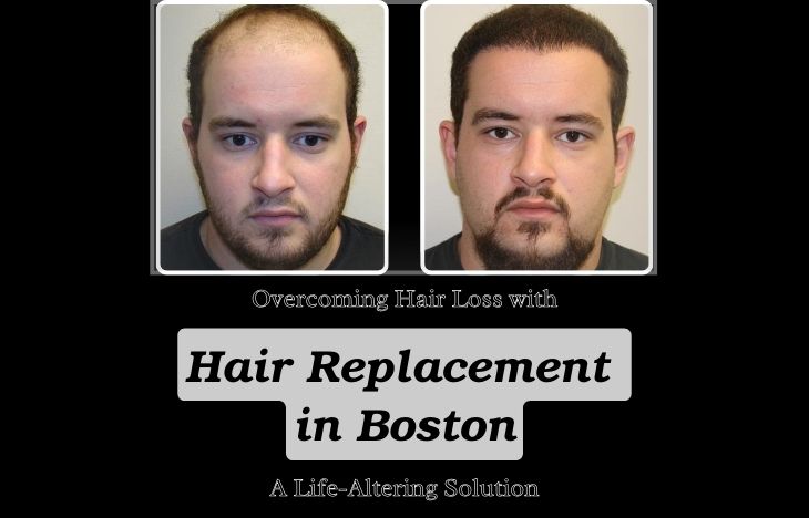 Overcoming-Hair-Loss-with-Hair-Replacement-in-Boston-A-Life-Altering-Solution